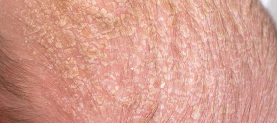 Psoriasis du cuir chevelu