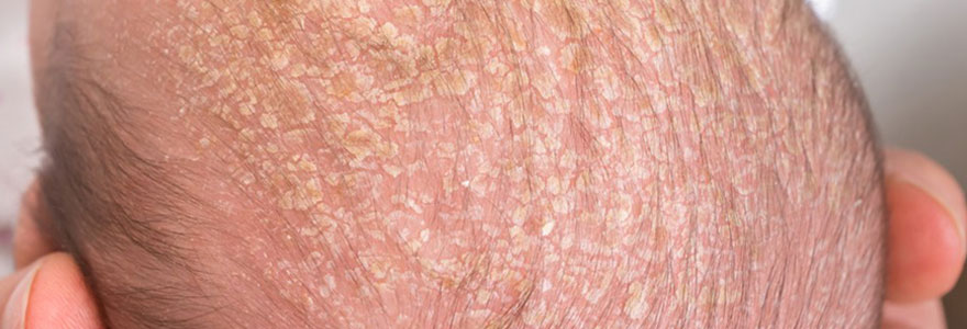 Psoriasis du cuir chevelu