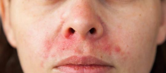 le psoriasis du visage