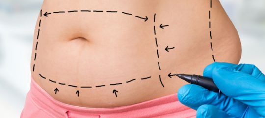 Abdominoplastie