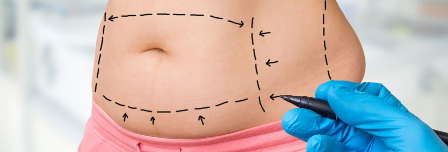 Abdominoplastie