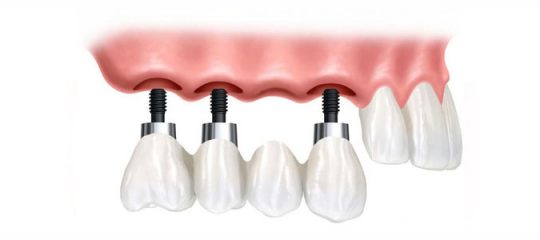 implant basal