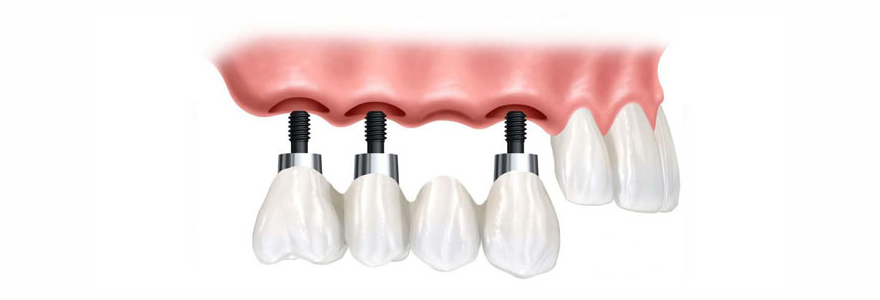 implant basal