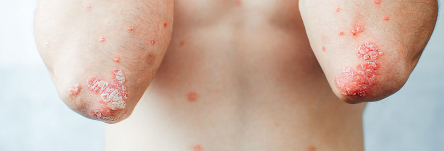 psoriasis en goutte